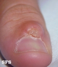 warts vulgaris