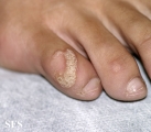 warts vulgaris
