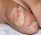 warts vulgaris