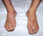warts vulgaris