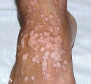 warts vulgaris