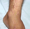 warts vulgaris