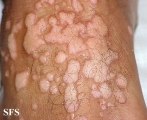 warts vulgaris