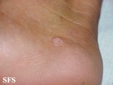 warts vulgaris