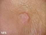 warts vulgaris