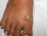 warts vulgaris