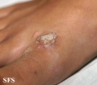 warts vulgaris