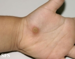 warts vulgaris