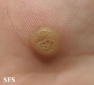 warts vulgaris