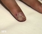 warts vulgaris
