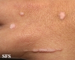 warts vulgaris