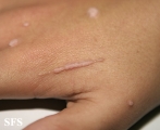warts vulgaris