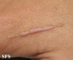 warts vulgaris