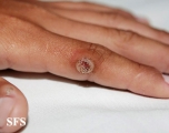warts vulgaris