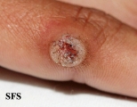 warts vulgaris