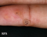 warts vulgaris