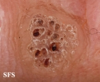 warts vulgaris
