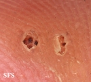 warts vulgaris