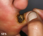 warts vulgaris