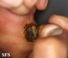 warts vulgaris