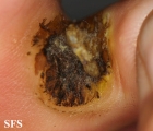 warts vulgaris