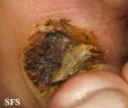 warts vulgaris