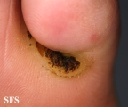 warts vulgaris