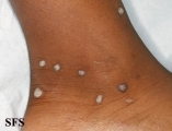 warts vulgaris