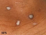 warts vulgaris