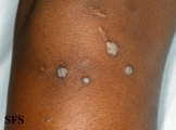 warts vulgaris