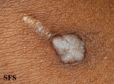 warts vulgaris