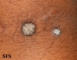 warts vulgaris