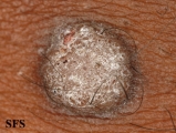 warts vulgaris