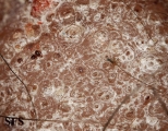 warts vulgaris