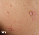 warts vulgaris