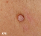 warts vulgaris