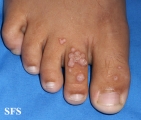 warts vulgaris