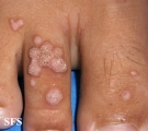 warts vulgaris