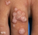 warts vulgaris