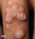 warts vulgaris