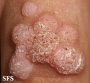 warts vulgaris