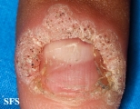 warts vulgaris