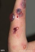 pemphigoid-bullous pemphigoid