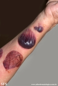 pemphigoid-bullous pemphigoid