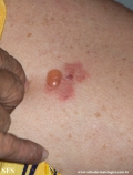 pemphigoid-bullous pemphigoid