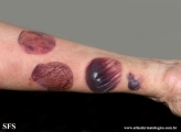 pemphigoid-bullous pemphigoid