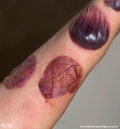 pemphigoid-bullous pemphigoid