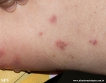 pemphigoid-bullous pemphigoid