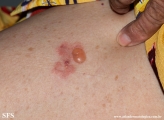 pemphigoid-bullous pemphigoid