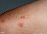 pemphigoid-bullous pemphigoid
